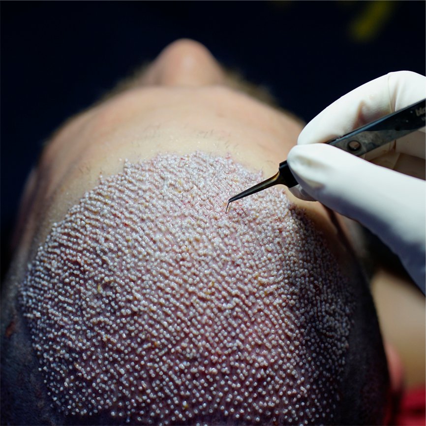 Beard Transplant at Yesilkoy Clinic