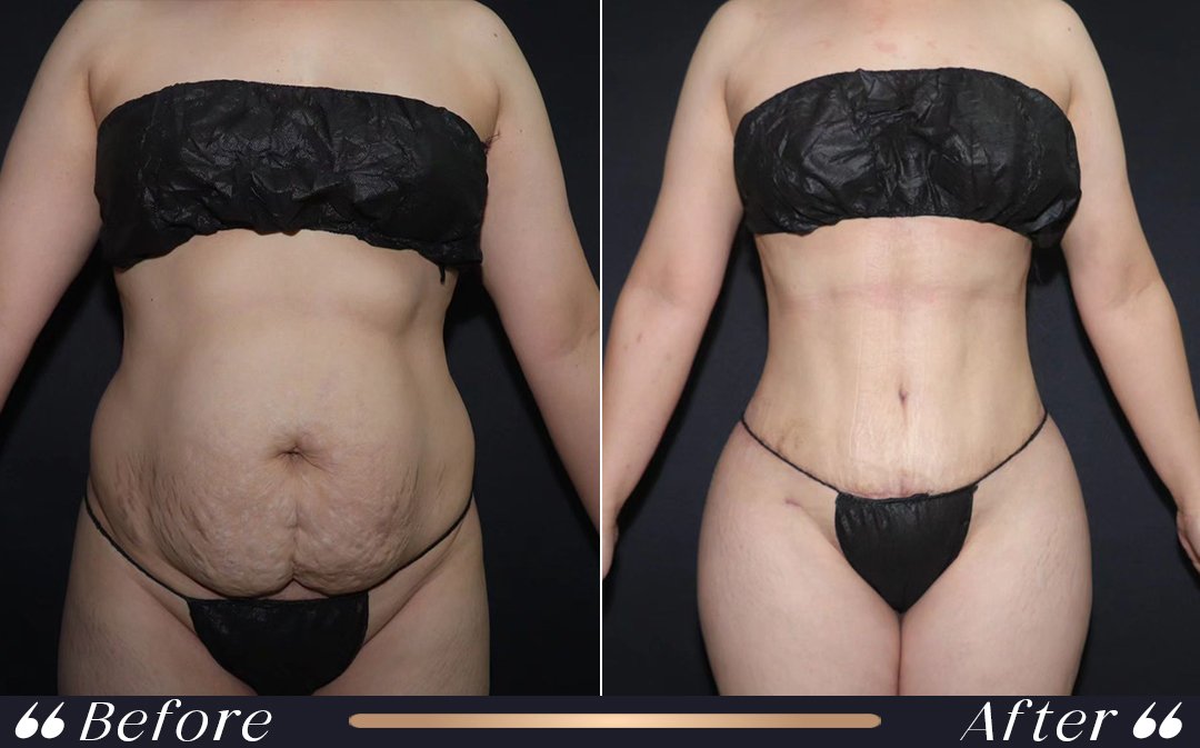 Mommy Makeover at Yesilkoy Clinic