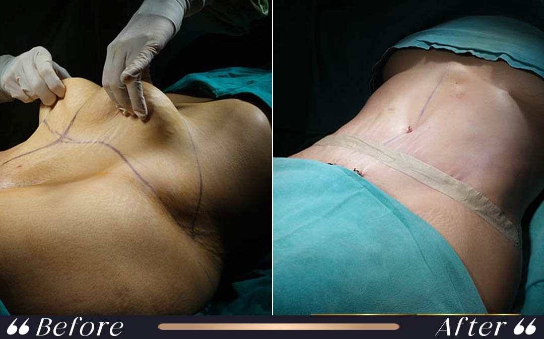Abdominoplasty Before and After