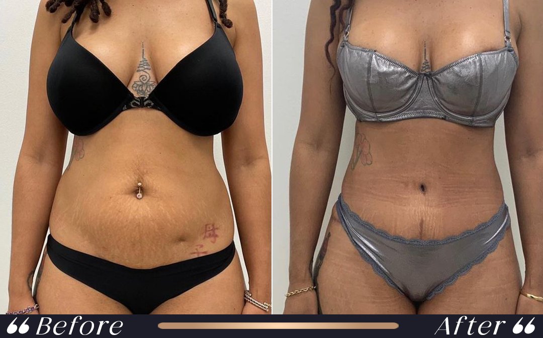 Tummy Tuck in Turkey and Recovery tummy tuck in turkey cost recovery planning
