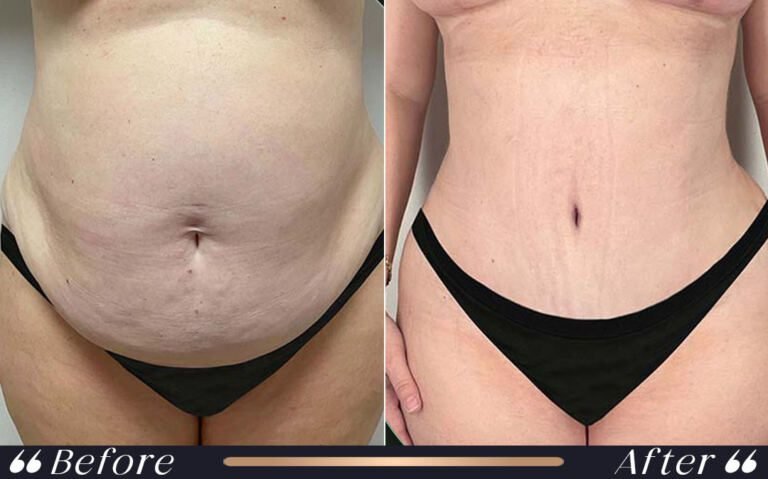 abdominoplasty_10