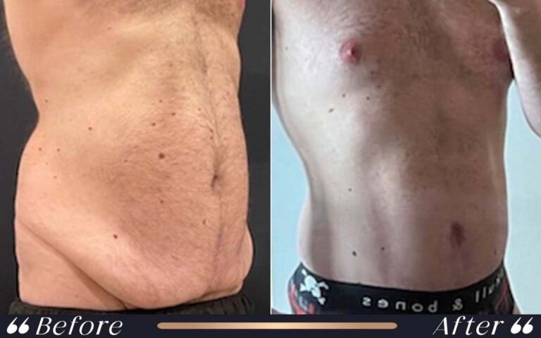 abdominoplasty_18
