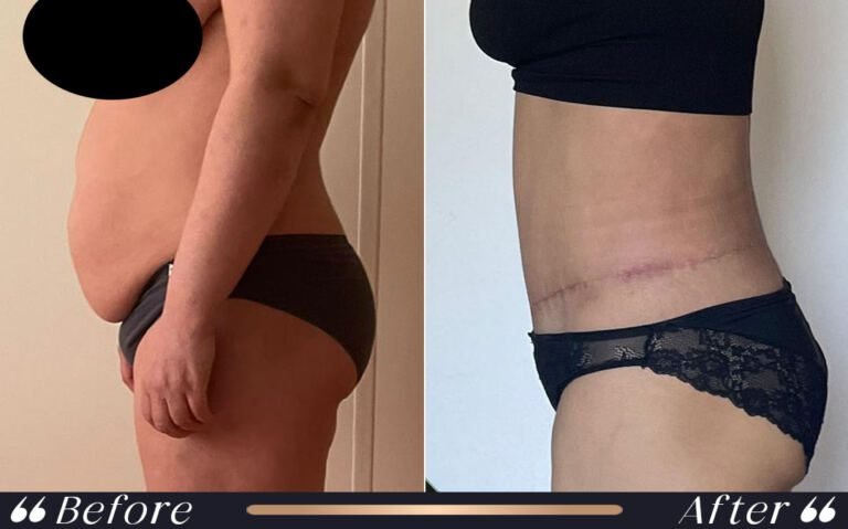 abdominoplasty_19
