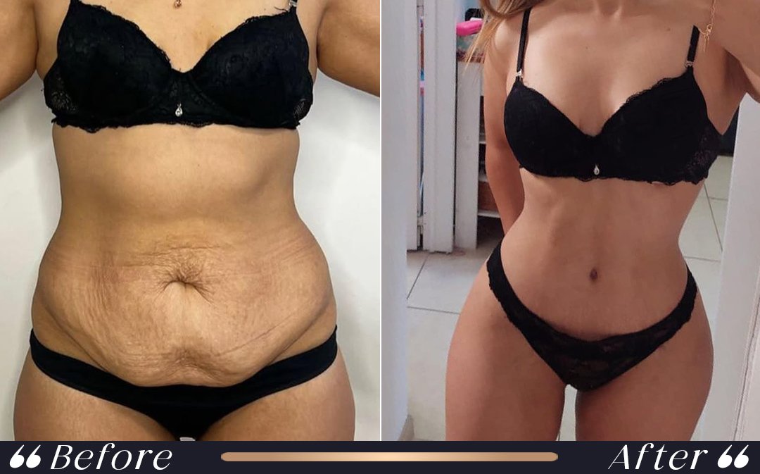 Tummy Tuck Turkey Package tummy tuck turkey package professional care