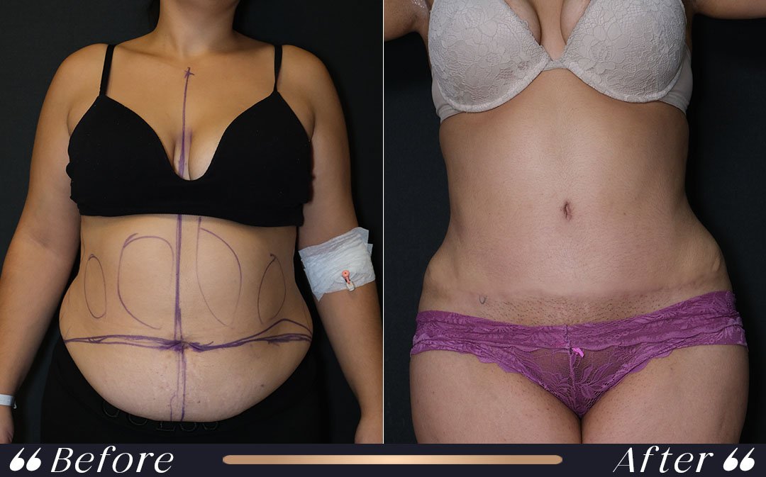 Mommy Makeover at Yesilkoy Clinic