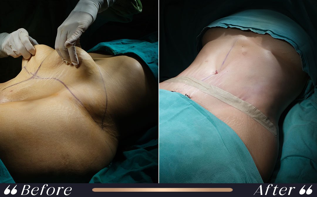 Tummy Tuck Turkey Cost and Abdominoplasty tummy tuck turkey cost abdominoplasty planning