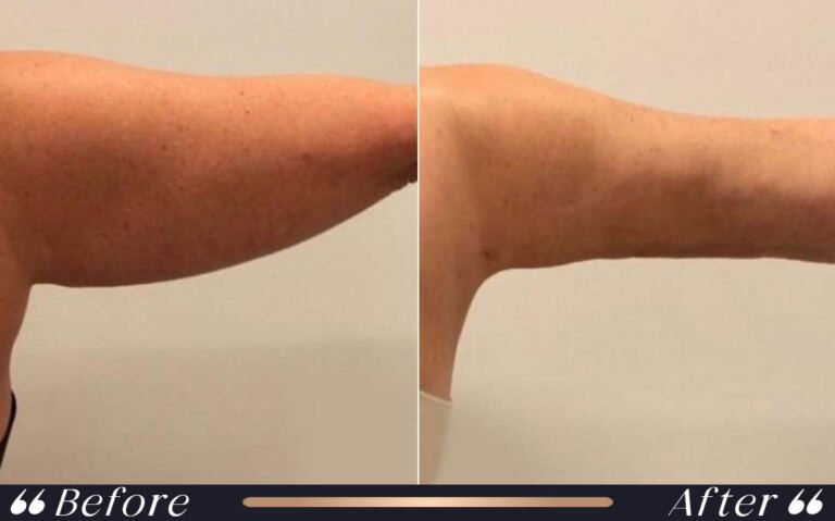arm_lift_1