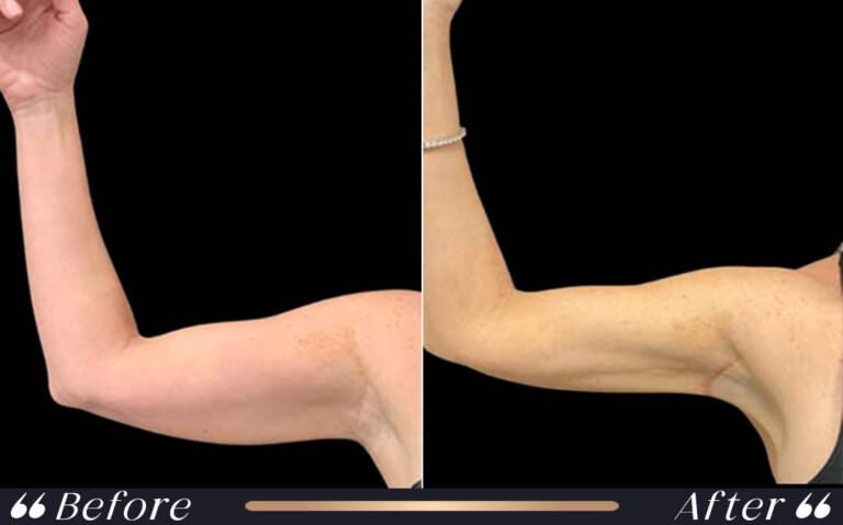 arm_lift_2