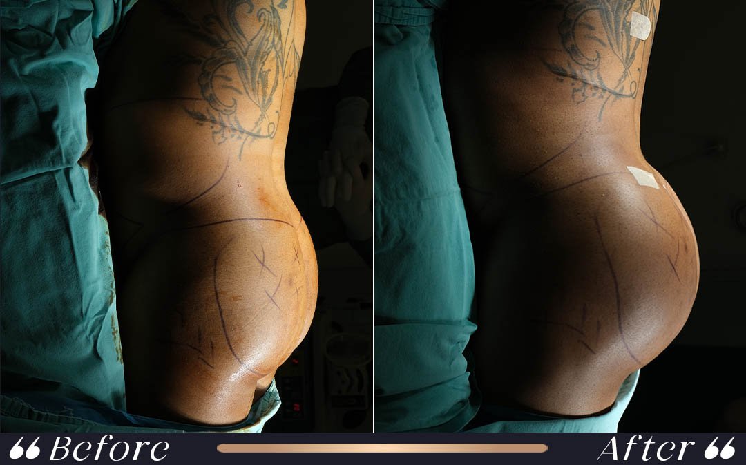 BBL Before and After