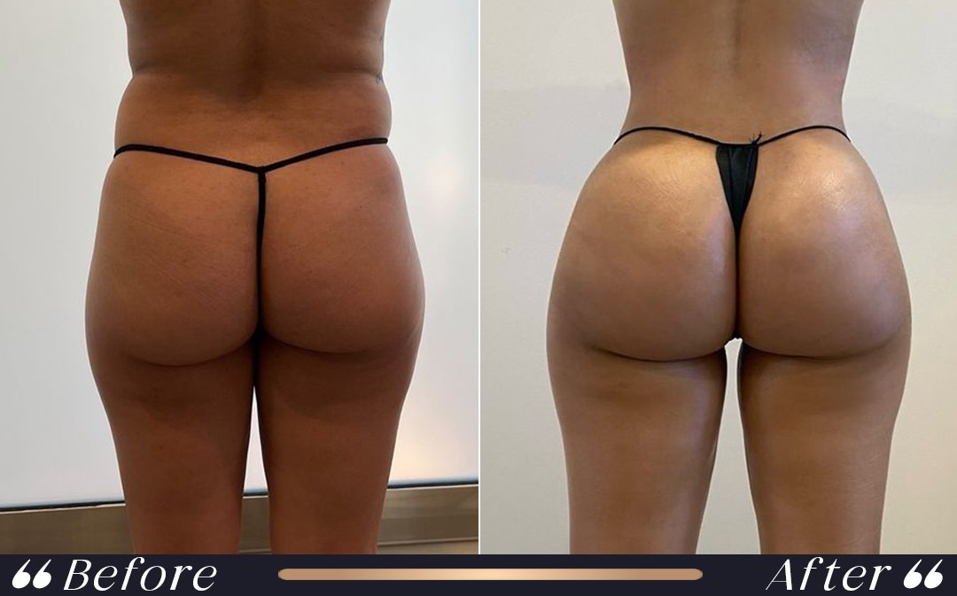 BBL recovery three months results and body contour