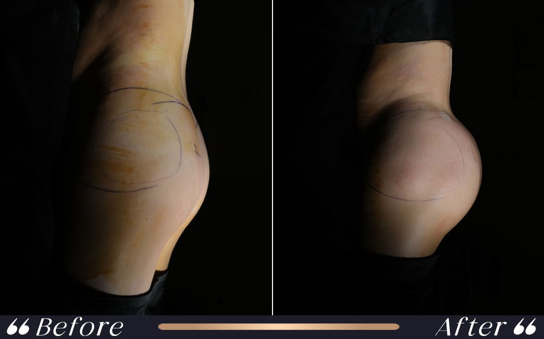 BBL recovery after Brazilian Butt Lift and liposuction