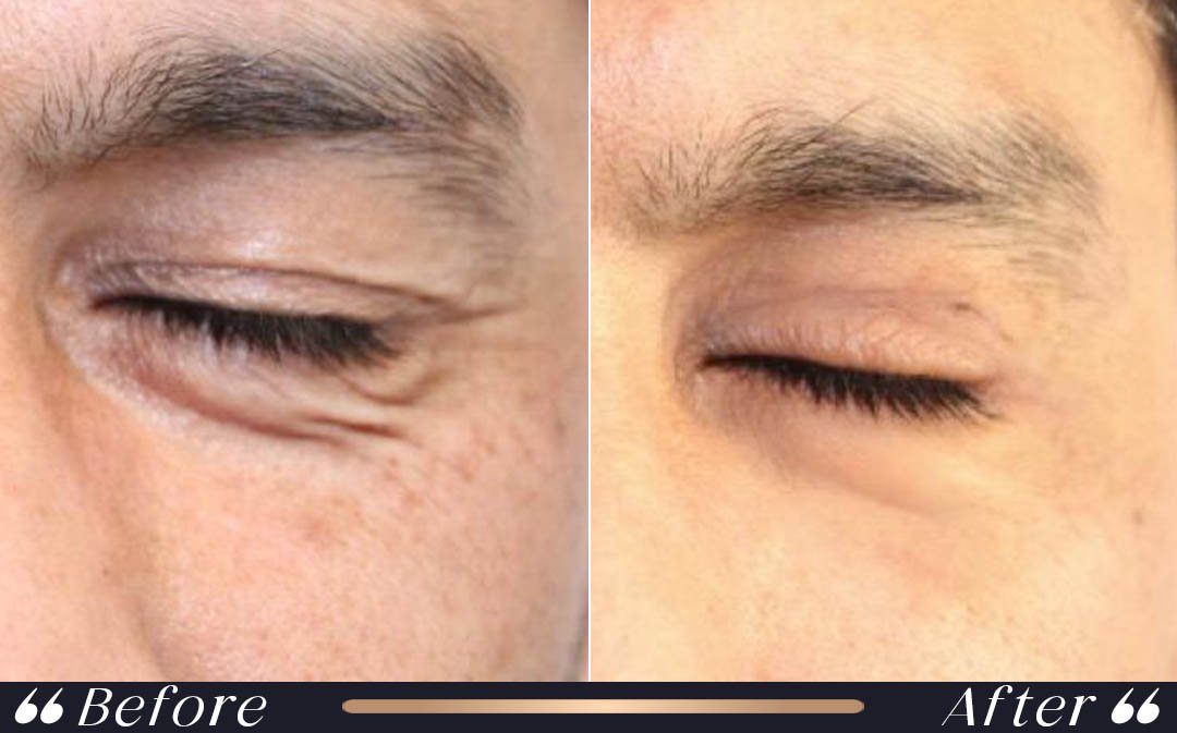 Blepharoplasty Turkey cost 2026 at Yeşilköy Clinic Istanbul