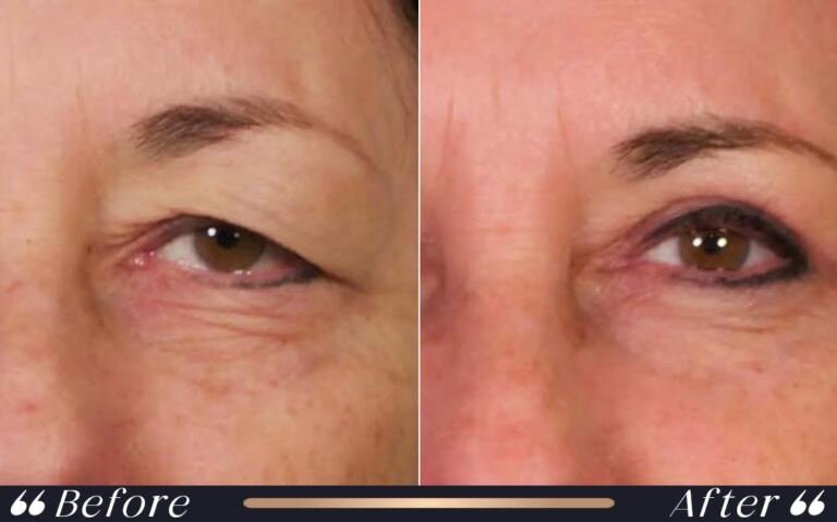 blepharoplasty_6
