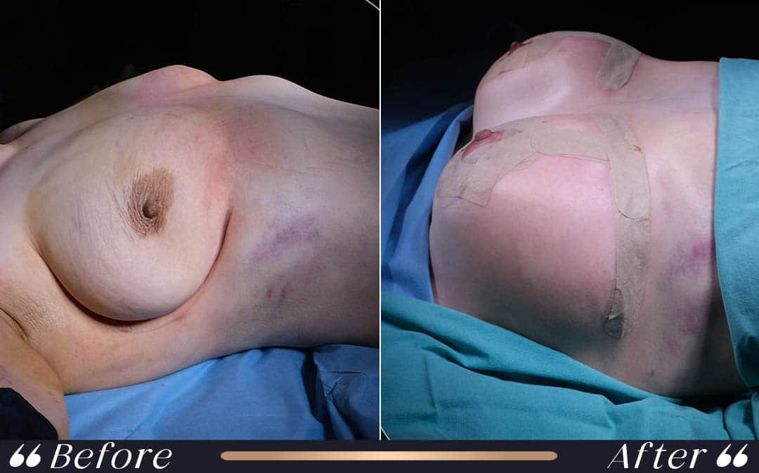 Breast surgery after pregnancy at Yesilkoy Clinic in Istanbul