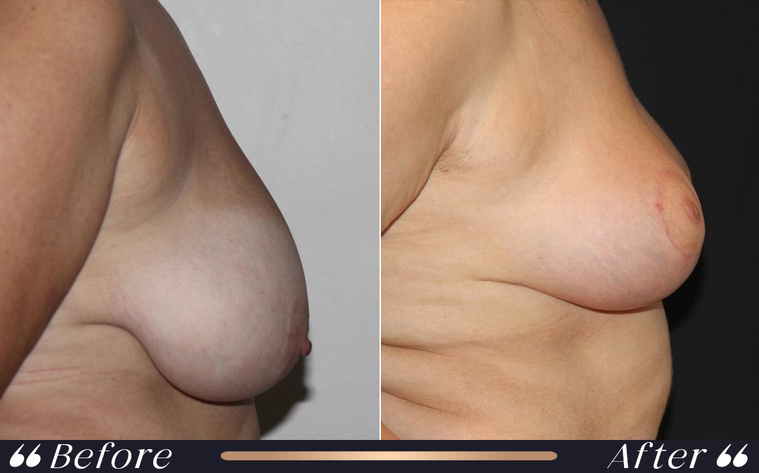 Breast reduction after pregnancy and breast reshaping