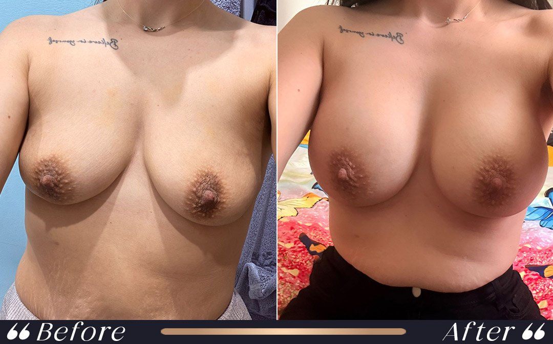 Breast Surgery Package in Turkey breast surgery in turkey plastic surgery packages