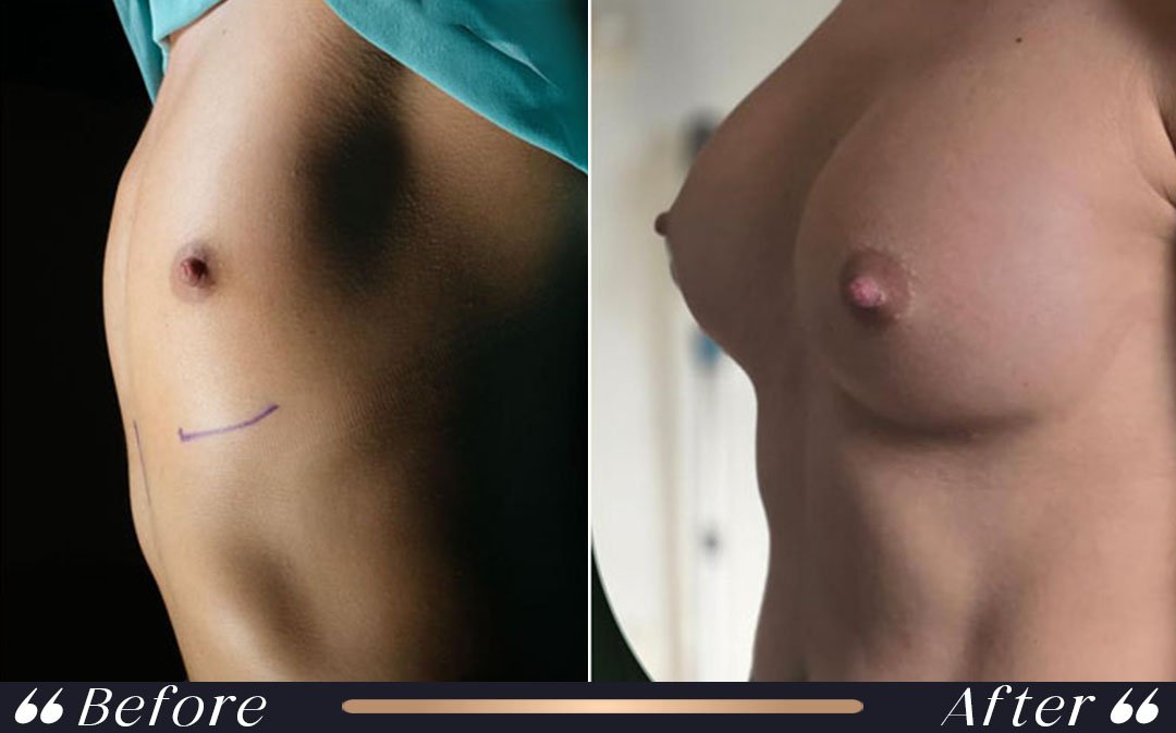 Breast Augmentation Turkey Cost and Implant Planning breast augmentation turkey cost and implant planning