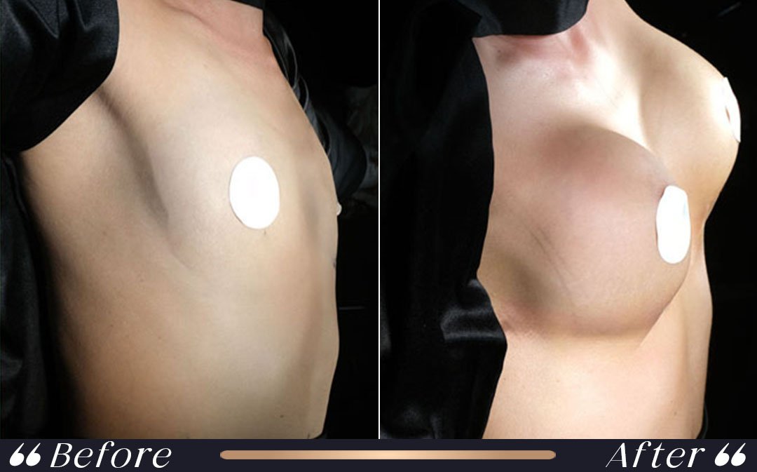 Breast Augmentation at Yesilkoy Clinic