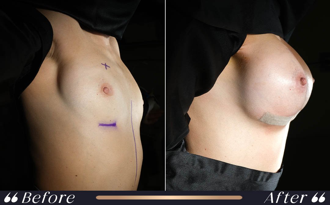Breast Surgery at Yesilkoy Clinic