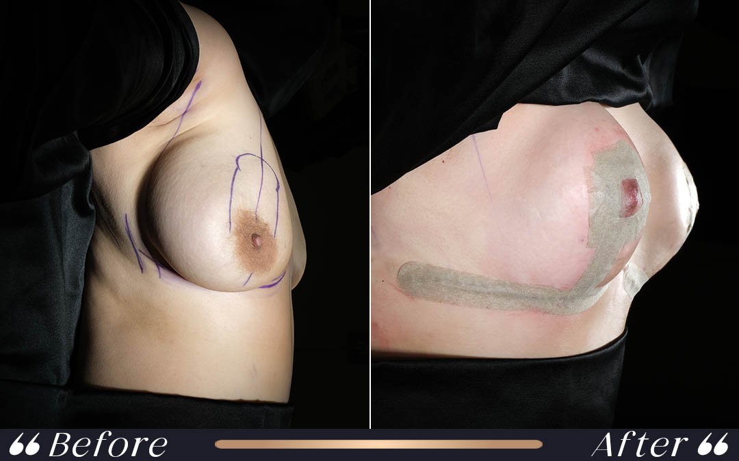 Breast Reduction at Yesilkoy Clinic