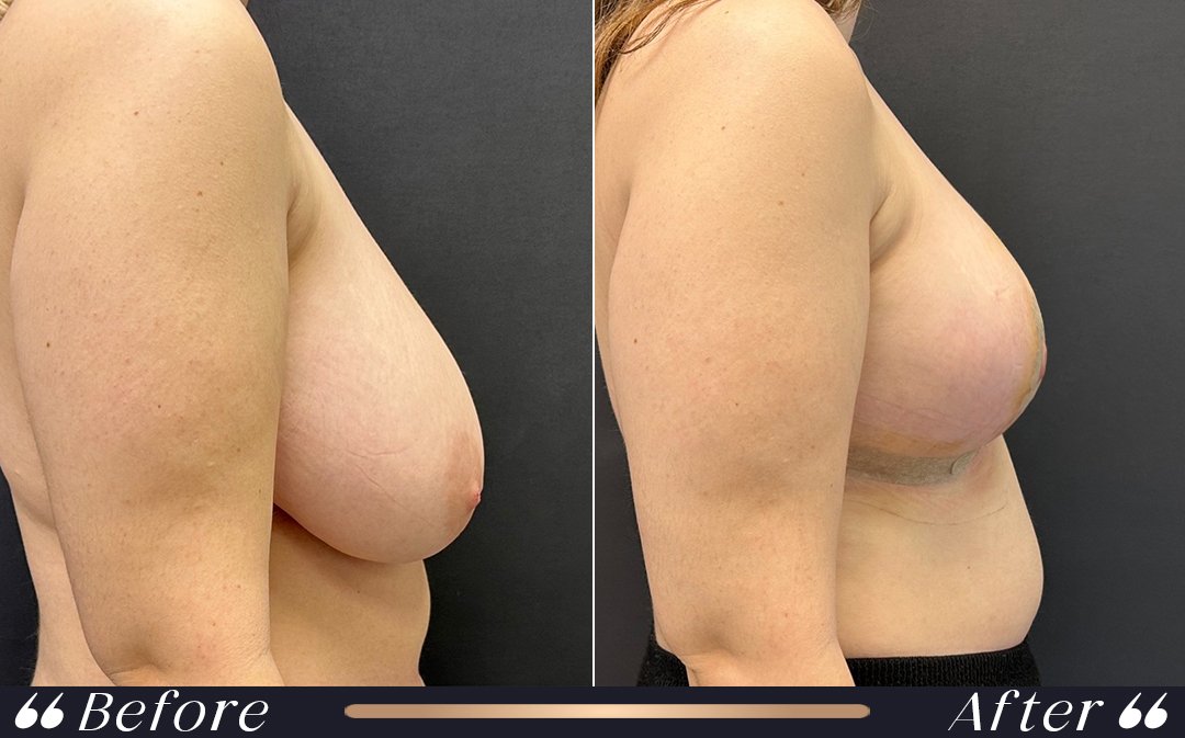 Breast Reduction at Yesilkoy Clinic