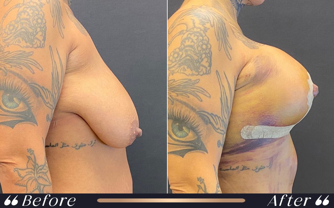 Breast Augmentation at Yesilkoy Clinic