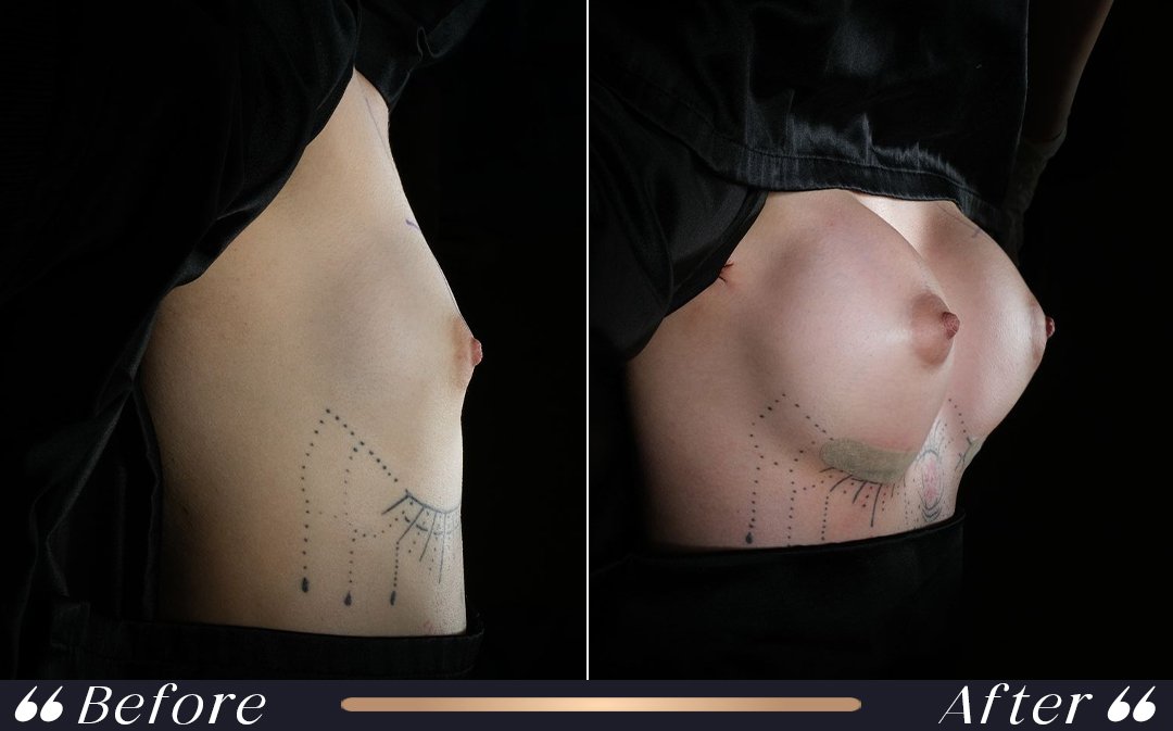 Breast Reduction at Yesilkoy Clinic