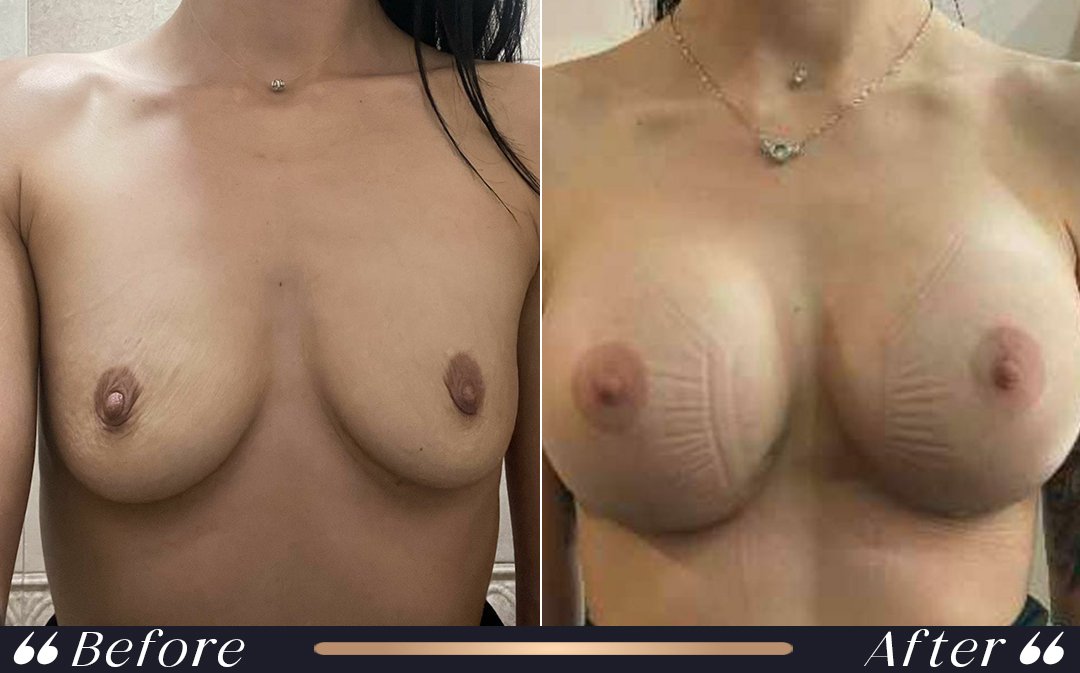 Breast Lift Mastopexy breast lift procedure in breast lift vs augmentation comparison