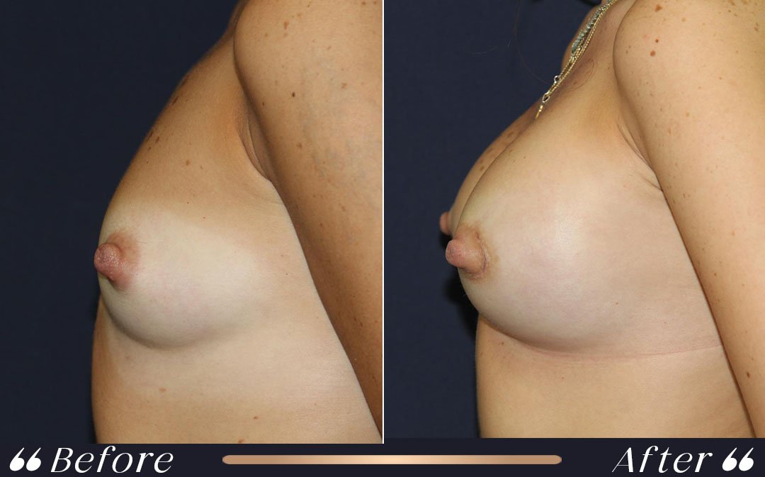 Breast Augmentation breast augmentation in breast lift vs augmentation comparison