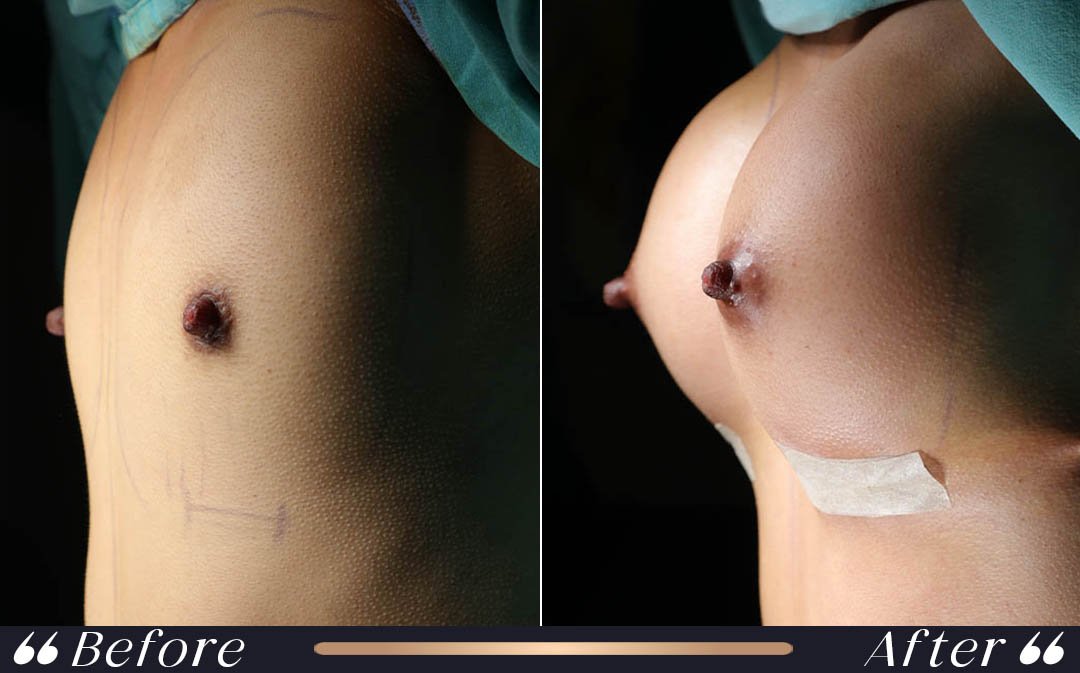 Breast Lift Mastopexy at Yesilkoy Clinic