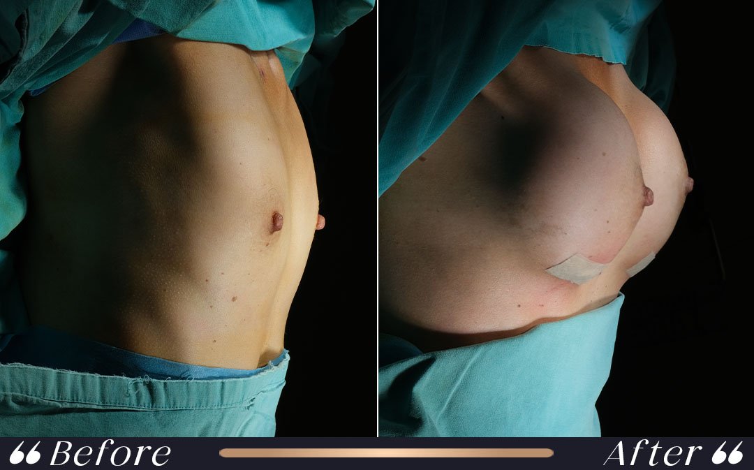 Breast augmentation recovery timeline at Yeşilköy Clinic Istanbul