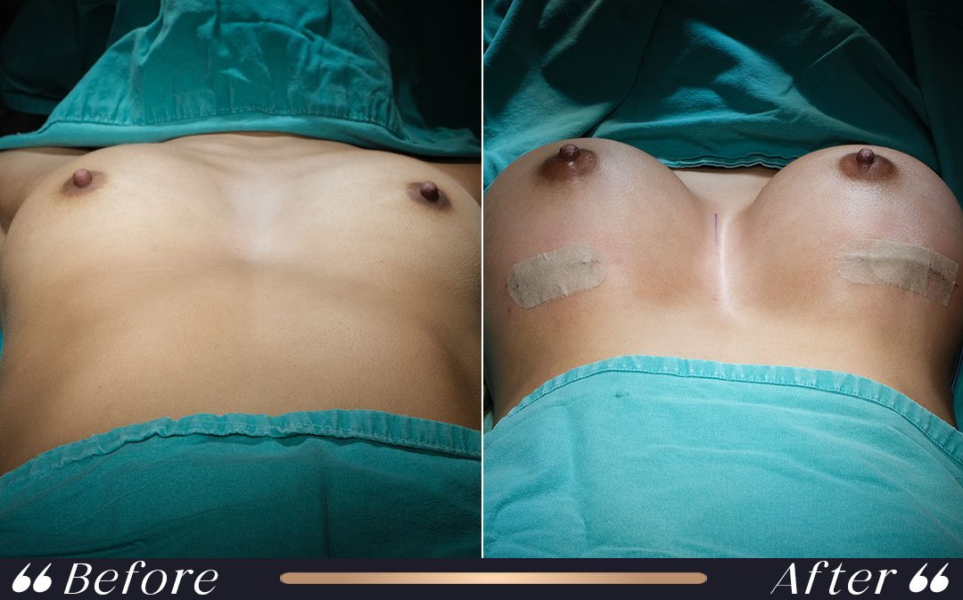 Breast Lift vs Augmentation After Volume Loss breast lift vs augmentation after pregnancy and weight loss