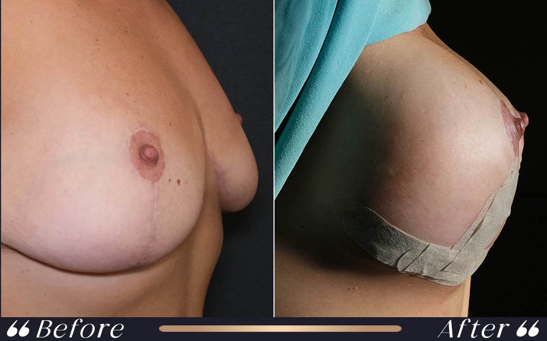 Breast Augmentation at Yesilkoy Clinic