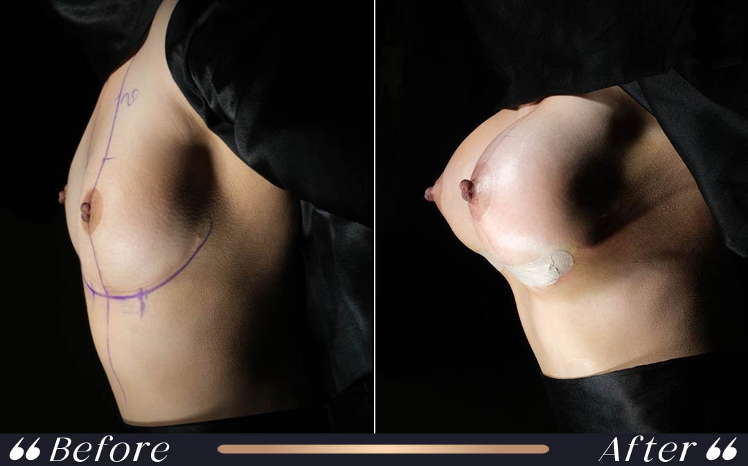 Breast Lift Mastopexy at Yesilkoy Clinic