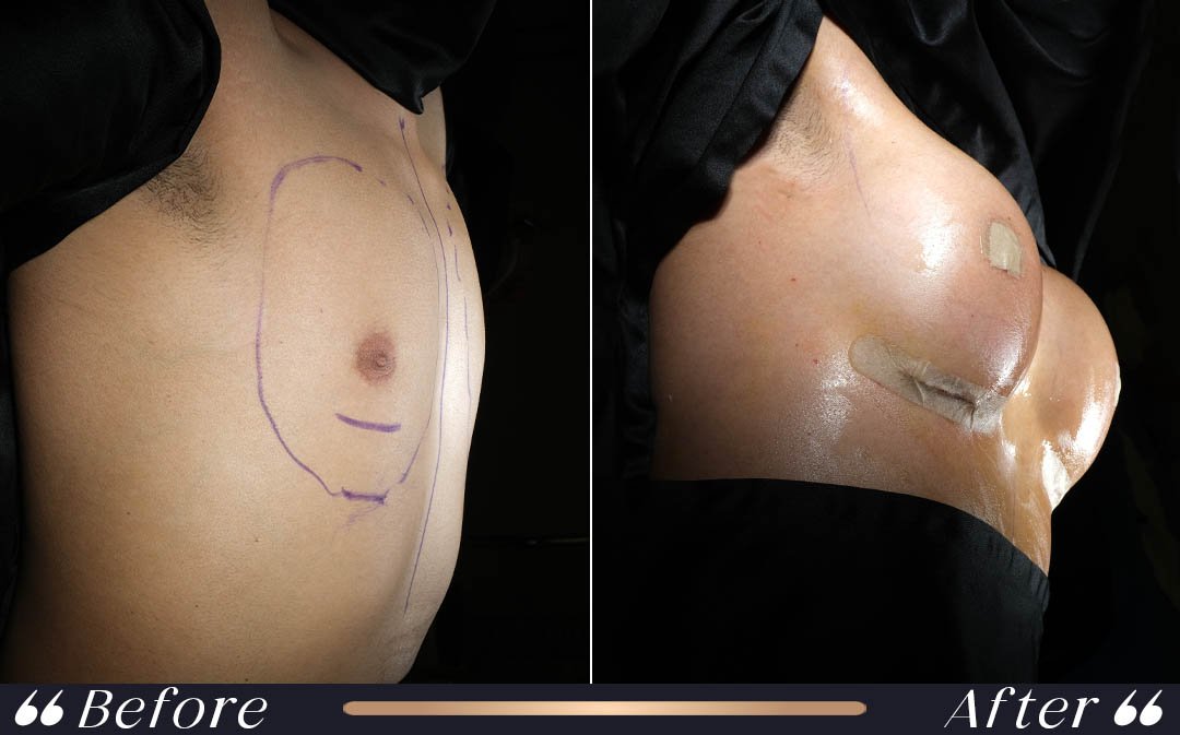 Breast augmentation recovery first week after breast implant surgery