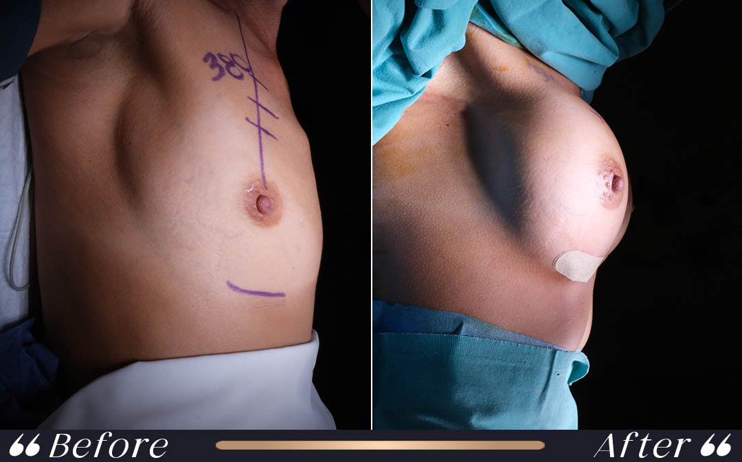 Breast Lift vs Augmentation breast lift vs augmentation comparison at Yesilkoy Clinic