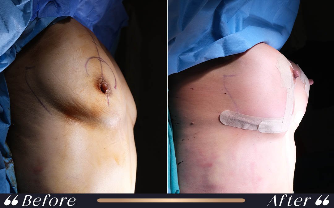 Breast Lift Mastopexy at Yesilkoy Clinic