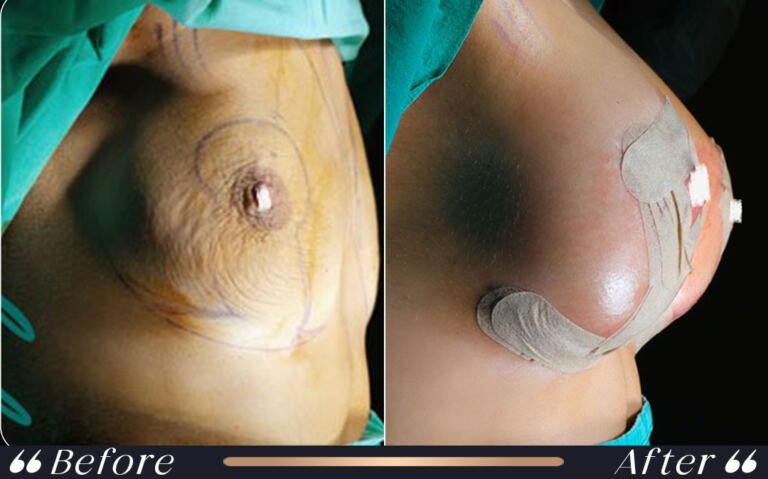breast_lift_13