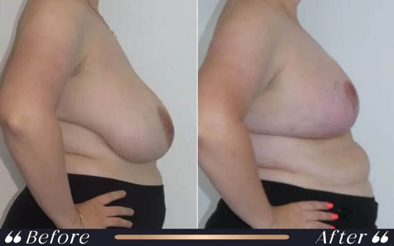 breast_lift_16
