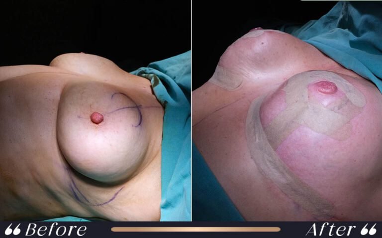 breast_lift_2