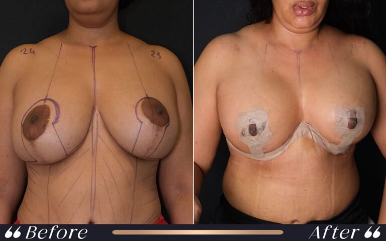 breast_lift_24