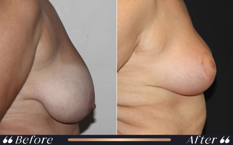 breast_reduction_4