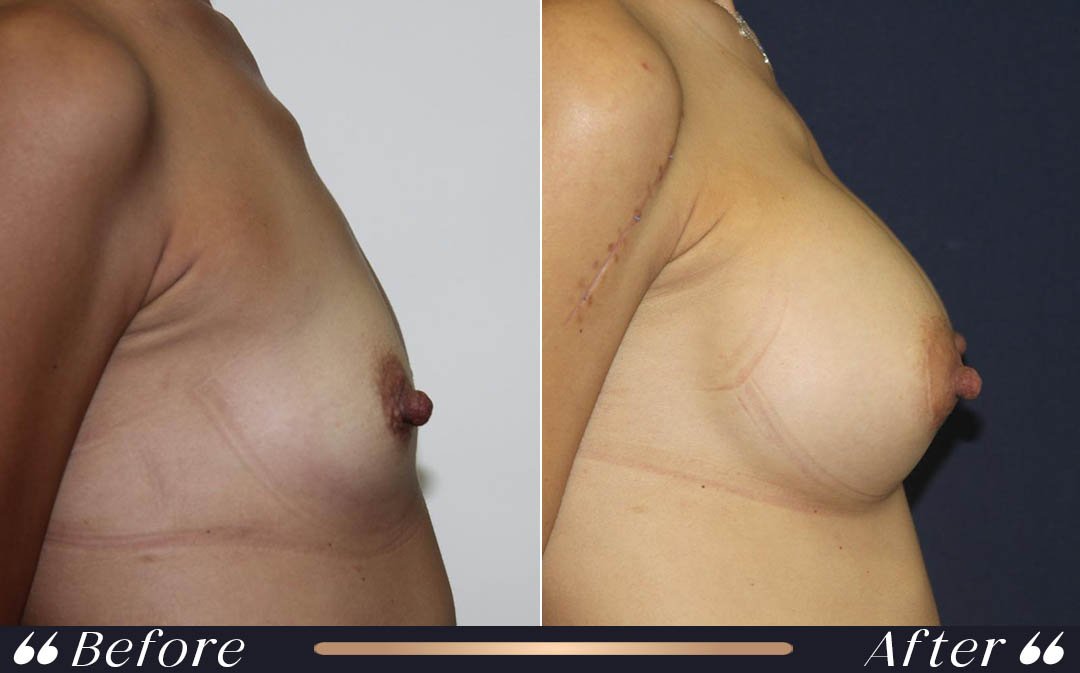 Breast augmentation Turkey cost silicone breast implant options