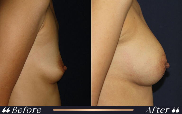 breast_silicon_18