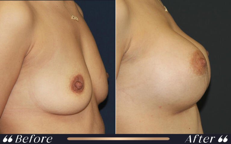 breast_silicon_19