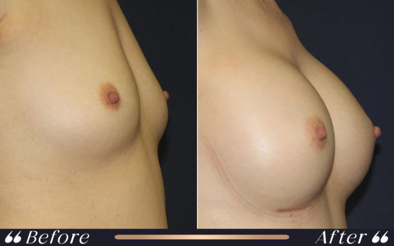 breast_silicon_20