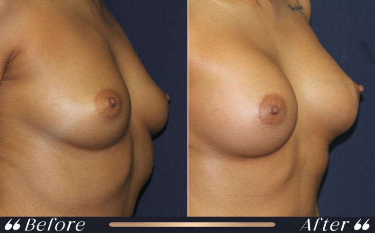 breast_silicon_21