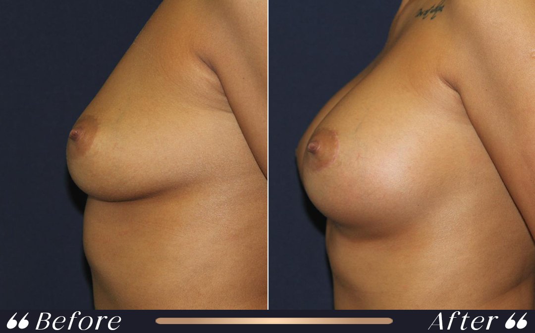 Breast augmentation Turkey cost specialist surgery Yeşilköy Clinic