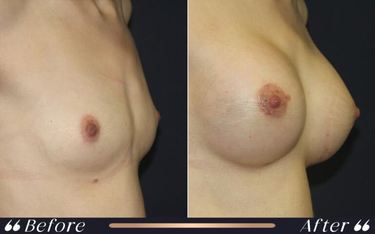 breast_silicon_23