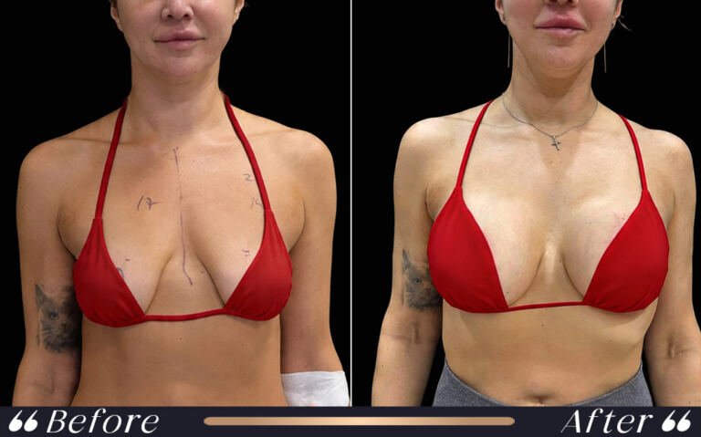 breast_silicon_27